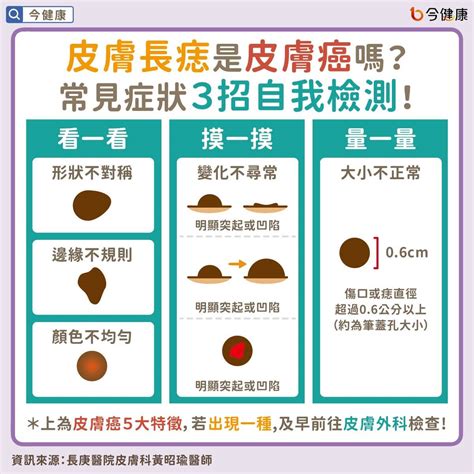 陰莖長痣|陰囊上的痣：正常嗎？該去看皮膚科嗎？